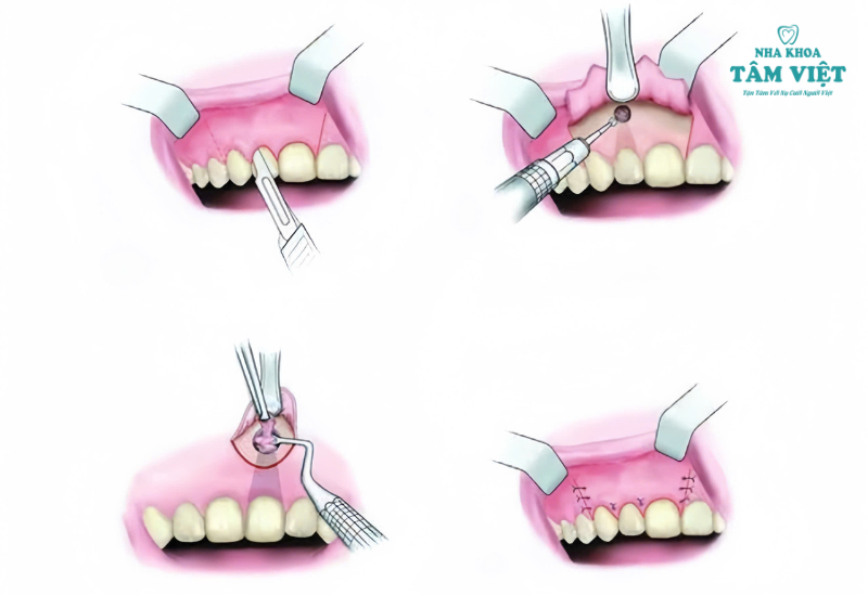 Cắt chóp răng là loại bỏ phần chóp răng bị viêm nhiễm