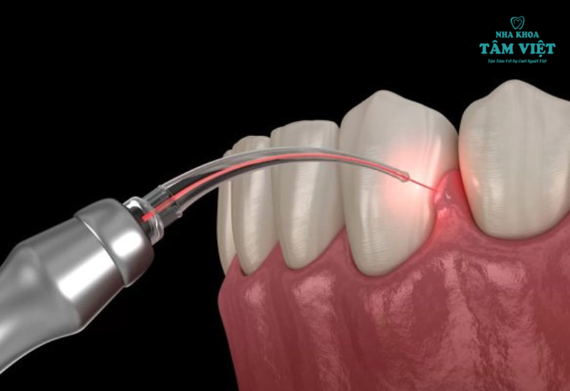 Phẫu thuật nướu: Giải pháp hiệu quả cho nụ cười hoàn hảo