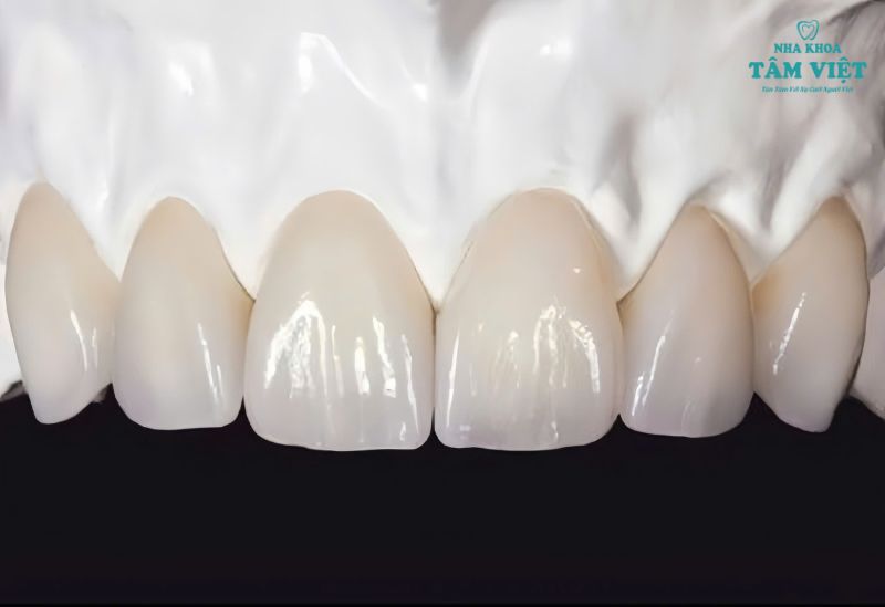 Răng sứ DDBio có tốt không? Ưu nhược điểm của DDBiO 3 Răng sứ DDBio nổi bật với độ bền