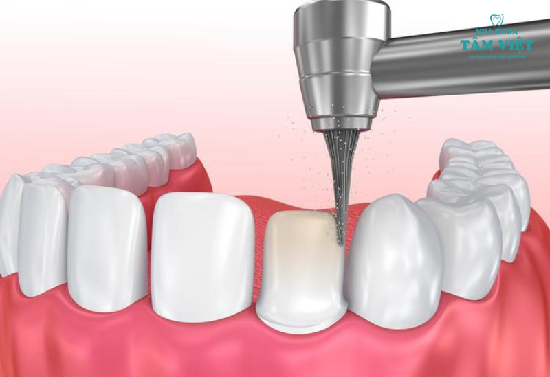 Mài cùi răng có thể gây ê buốt răng thật