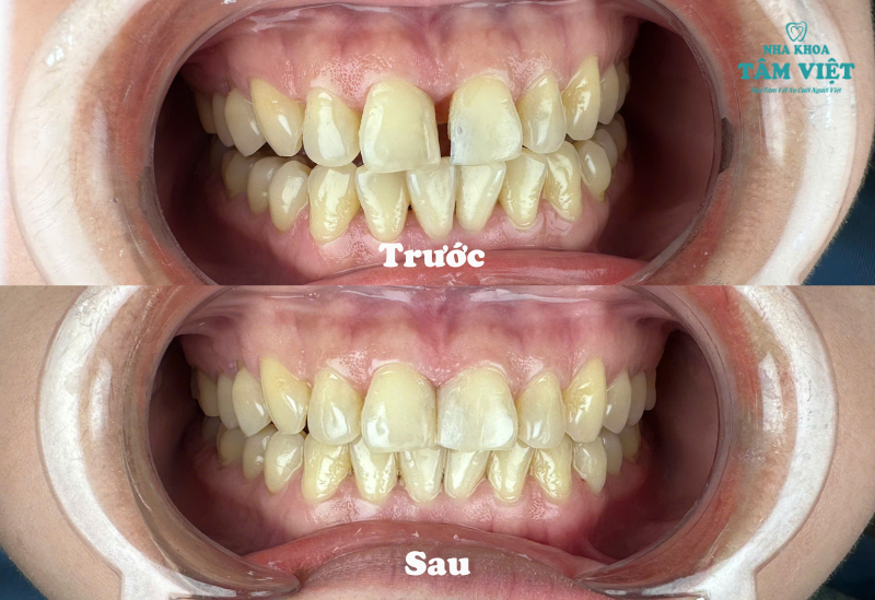 Trám răng thẩm mỹ