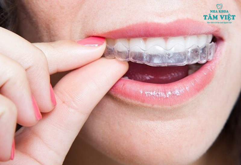 Niềng răng tháo lắp Invisalign