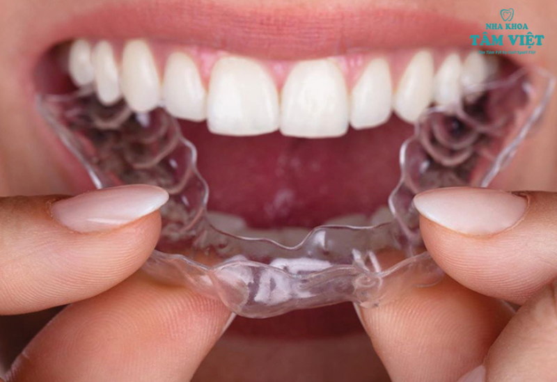 Niềng răng Invisalign có thẩm mỹ đẹp