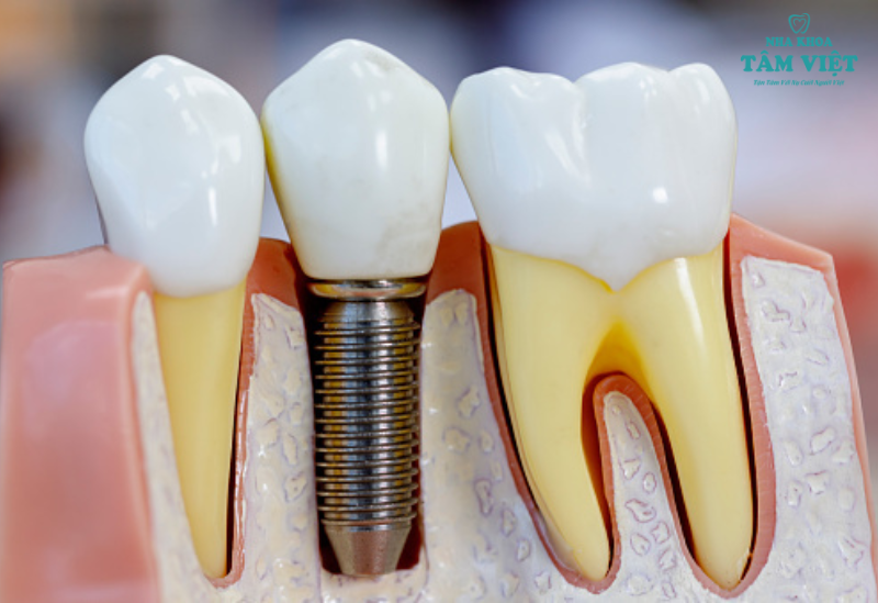 trồng răng implant ở đâu