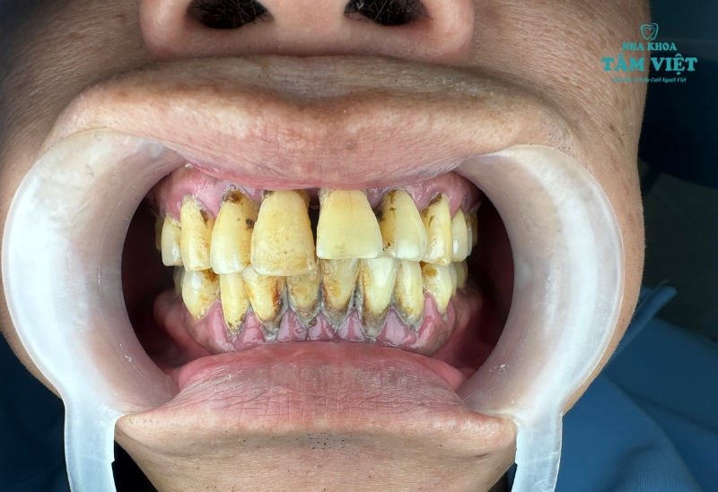 Khi nào cần bọc răng sứ nguyên hàm?