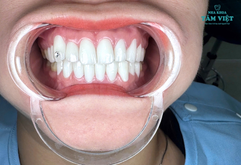 Đâu là địa chỉ nha khoa uy tín để bọc sứ?