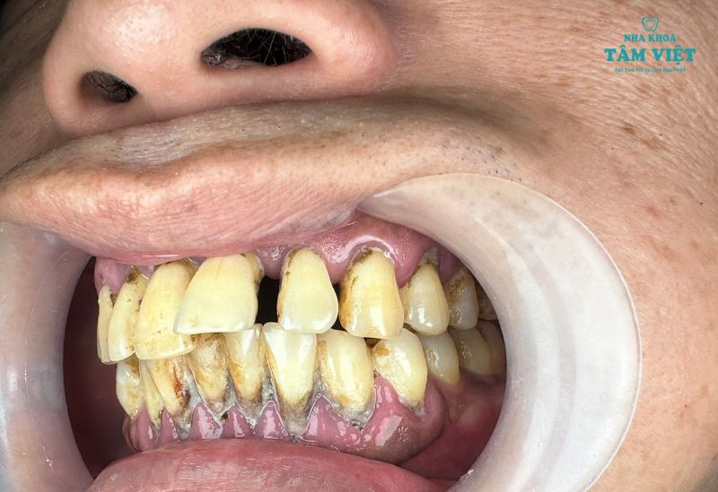 Bọc răng sứ có hết hô không? Những điều cần lưu ý 2 Bọc răng sứ có hết hô không? Điều này đúng hay sai?