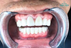 Bọc răng sứ có tốt không? Tìm hiểu ưu và nhược điểm