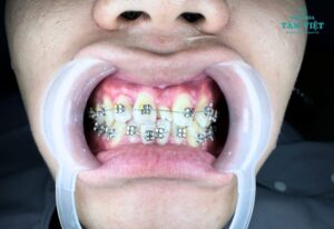 Chi phí niềng răng 2 hàm bao nhiêu là hợp lý?