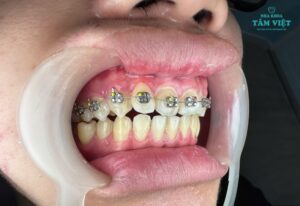 Có nên niềng răng cho trẻ em không và những điều cần biết