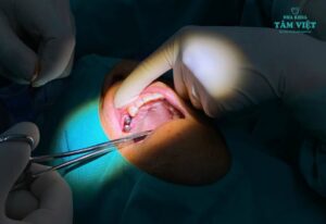 Giá cấy ghép Implant có mắc khôn