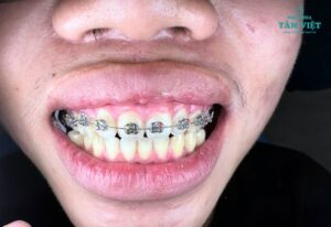 Hô nhẹ có nên niềng răng để cải thiện thẩm mỹ?