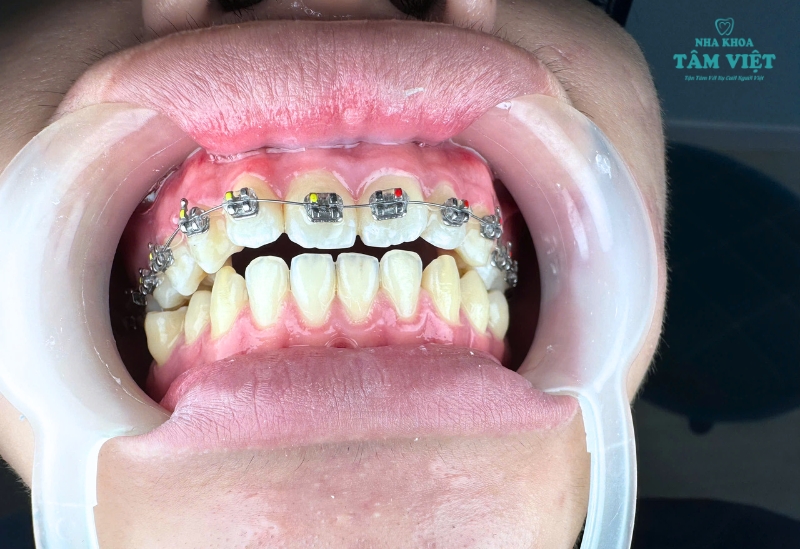 Mấy tuổi nên niềng răng là tốt nhất? Những điều cần lưu ý 2 Mấy tuổi nên niềng răng là tốt nhất?