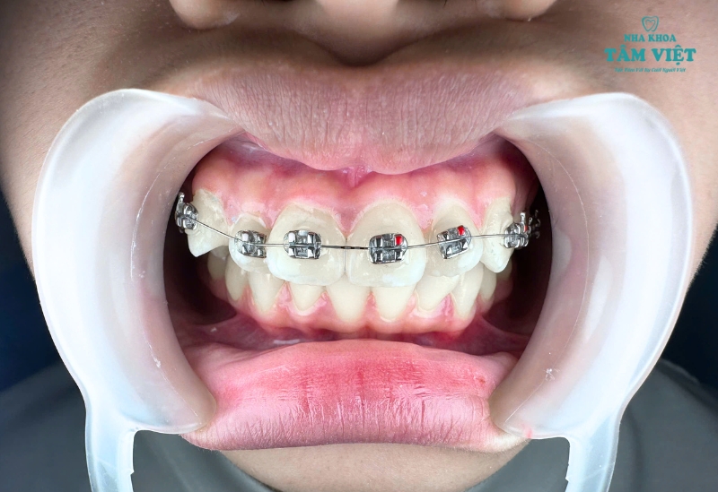 Mấy tuổi nên niềng răng là tốt nhất? Những điều cần lưu ý 3 Các độ tuổi niềng răng và mức độ phù hợp