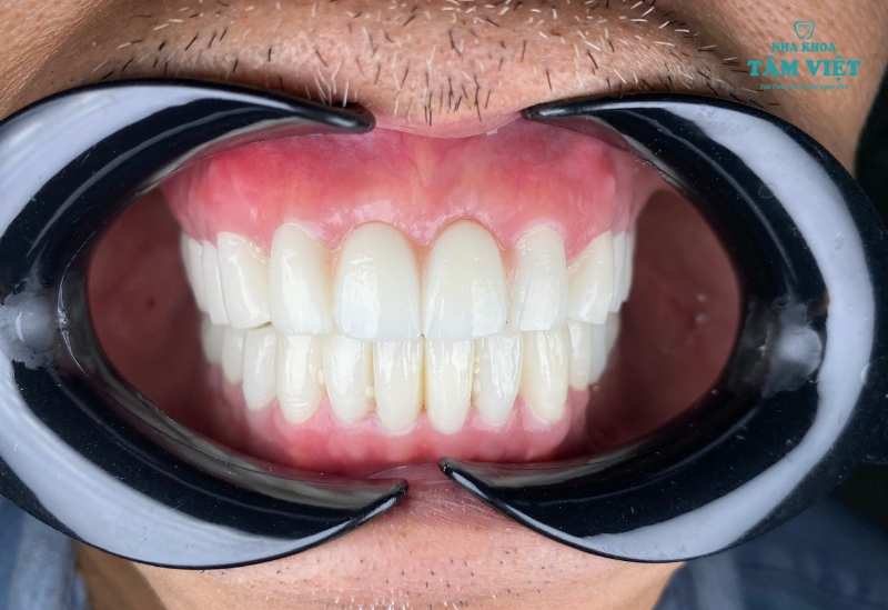Địa chỉ nha khoa răng sứ gần đây uy tín không nên bỏ lỡ