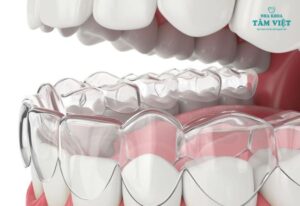 Niềng răng Invisalign có hiệu quả không?