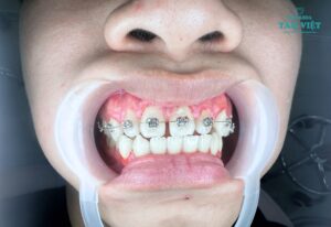 Niềng răng mắc cài kim loại có đau không?