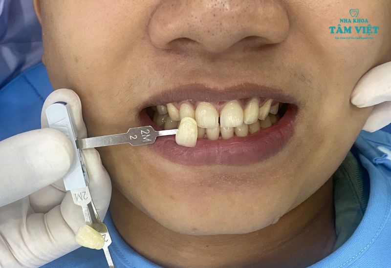 Địa chỉ tẩy trắng răng ở đâu tốt nhất tại TPHCM? 2 Khi nào thì nên cần tẩy trắng răng?