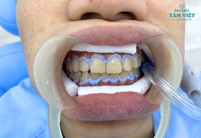Địa chỉ tẩy trắng răng ở đâu tốt nhất tại TPHCM?