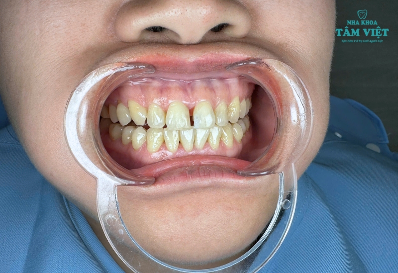 Chi phí trám răng sâu giá bao nhiêu? Ở đâu rẻ? 3 Các trường hợp cần trám răng sâu