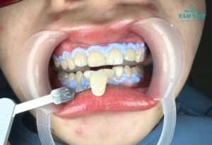 Có nên tẩy trắng răng ở nha khoa hay không?