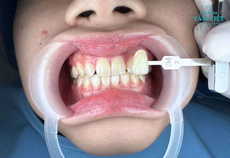 Có nên tẩy trắng răng ở nha khoa hay không? 3 Lợi ích của tẩy trắng răng ở nha khoa