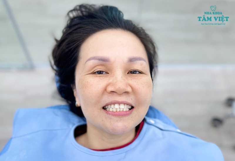 Dán sứ Veneer giá bao nhiêu 1 răng tại TPHCM? 3 Cần lưu ý những gì để tiết kiệm được chi phí dán sứ Veneer?