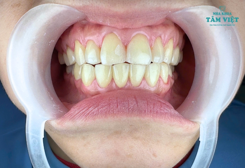 Dán sứ Veneer giá bao nhiêu 1 răng tại TPHCM?