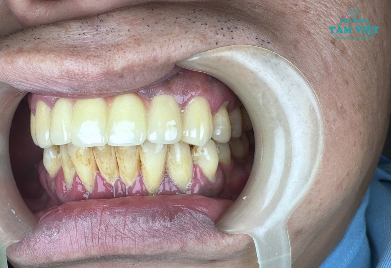 Vì sao cần lấy cao răng định kỳ?