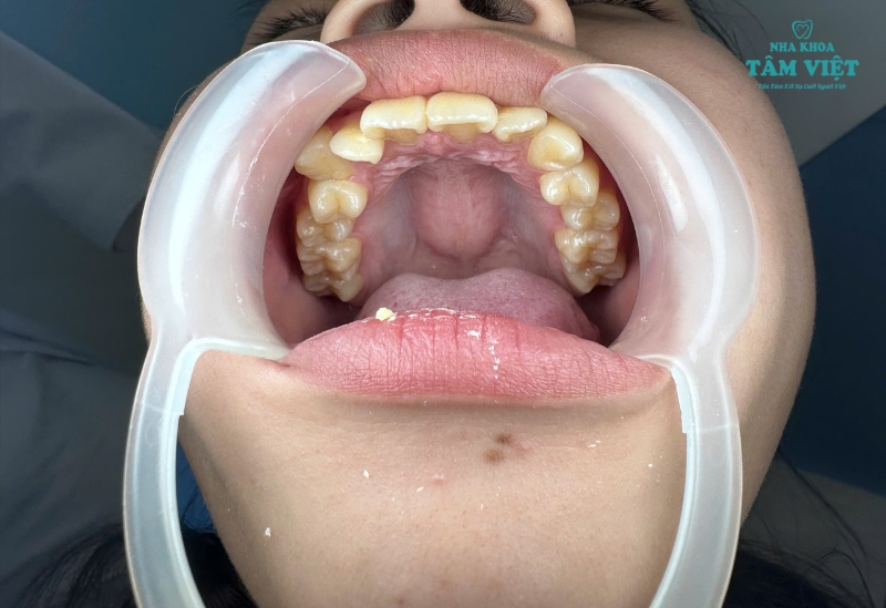 Bao lâu lấy cao răng một lần là tốt?