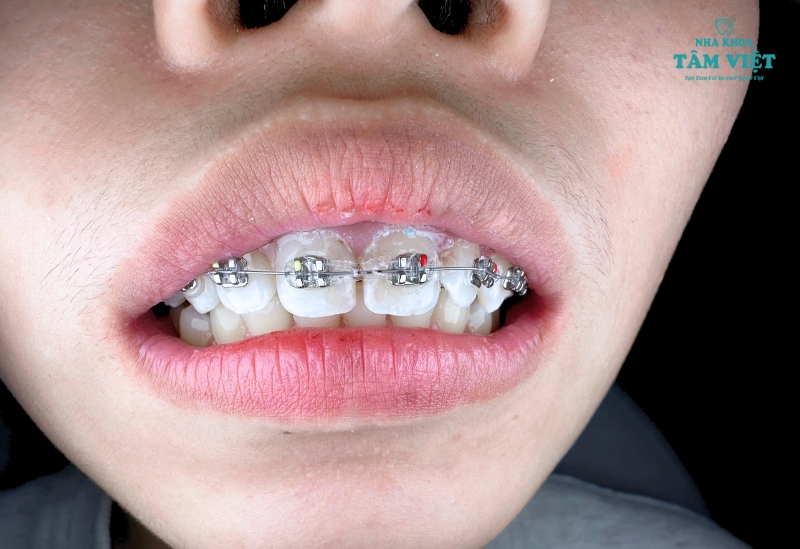 Niềng răng bao lâu thì tháo được? Cách tối ưu thời gian