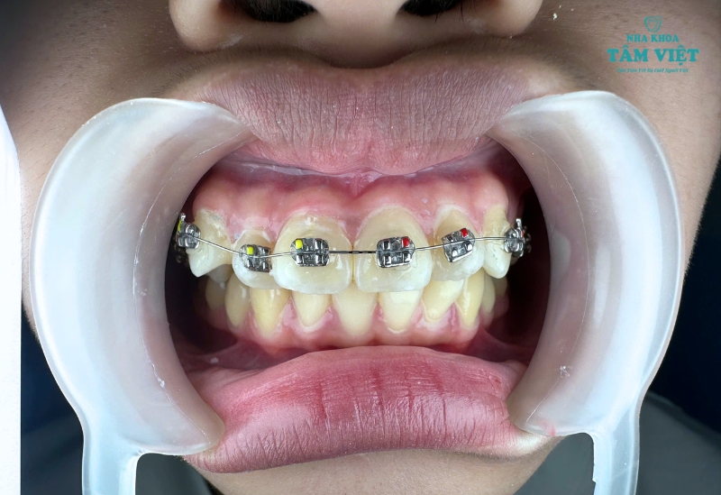 Niềng răng bao lâu thì tháo được? Cách tối ưu thời gian 4 Các giai đoạn trong quá trình niềng răng