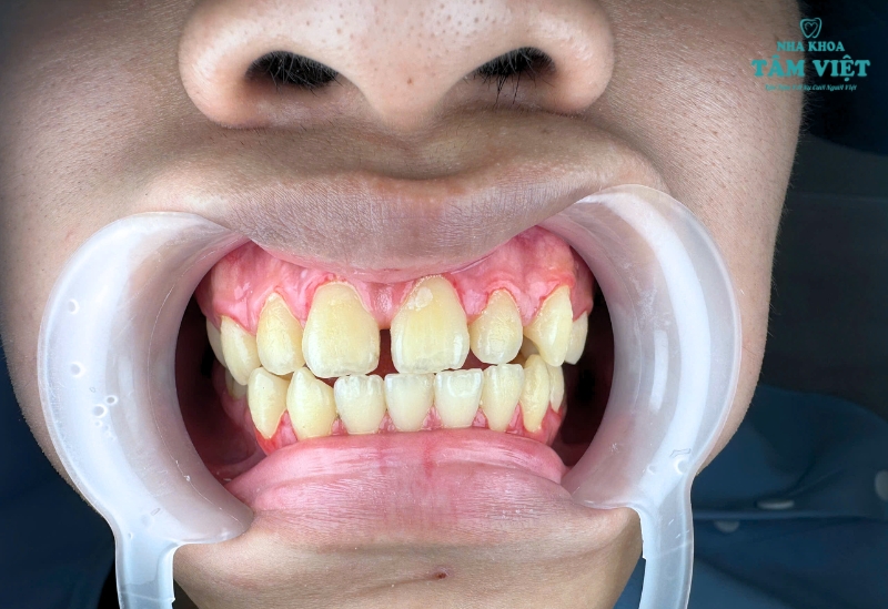 Niềng răng bao lâu thì tháo được? Cách tối ưu thời gian 3 Mức độ lệch lạc của răng