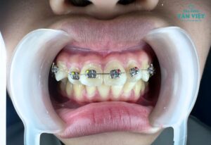 Niềng răng có tác dụng gì? Tại sao nên niềng răng?