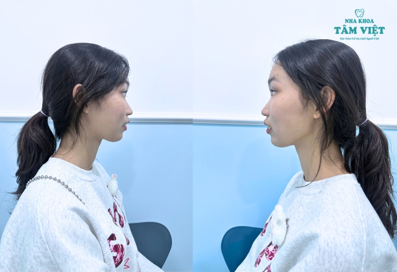 Niềng răng có tác dụng gì? Tại sao nên niềng răng? 4 Cải thiện thẩm mỹ khuôn mặt