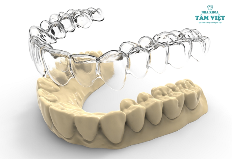 Niềng răng có tác dụng gì? Tại sao nên niềng răng? 3 Niềng răng không mắc cài Invisalign