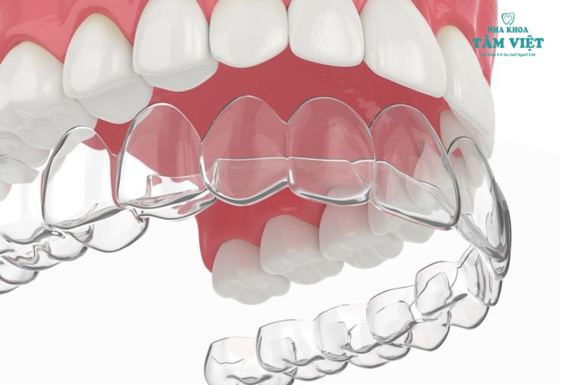 Hỏi đáp: Niềng răng trong suốt có đau không và một số lưu ý