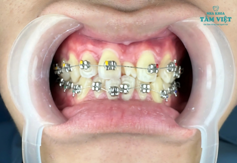 Hỏi đáp: Niềng răng trong suốt có đau không và một số lưu ý 3 Niềng răng mắc cài kim loại