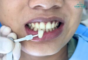 Tẩy trắng răng có hại không? Làm thế nào để an toàn?