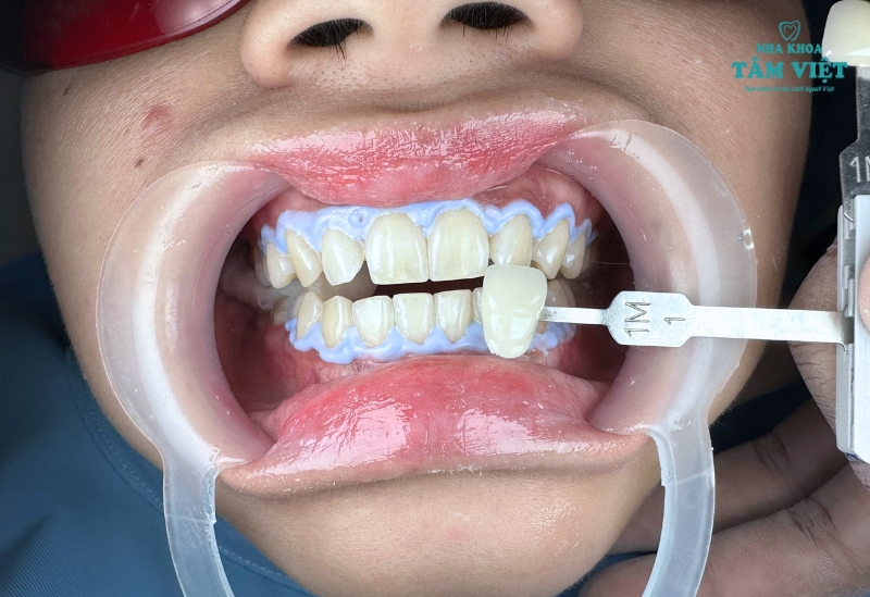 Tẩy trắng răng có hại không? Làm thế nào để an toàn? 2 Tẩy trắng răng có hại không?
