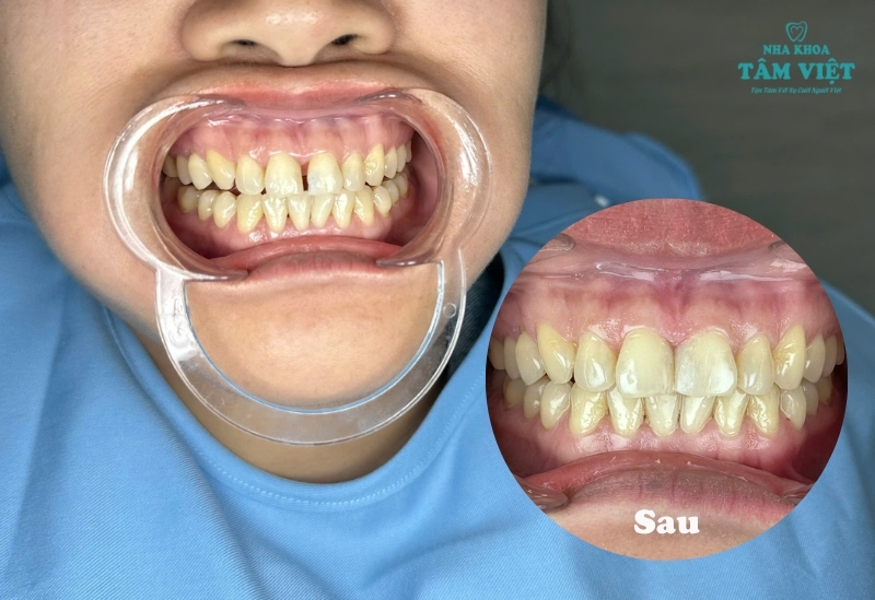 Trám răng cửa thẩm mỹ là gì? Trám răng Gò Vấp ở đâu tốt?