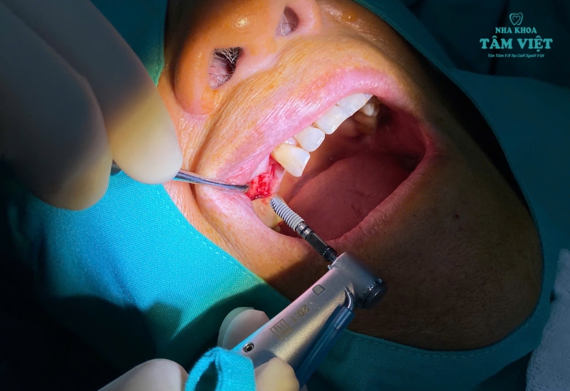 Trồng răng implant có nguy hiểm không? Những lưu ý quan trọng 2 Trồng răng implant có nguy hiểm không?