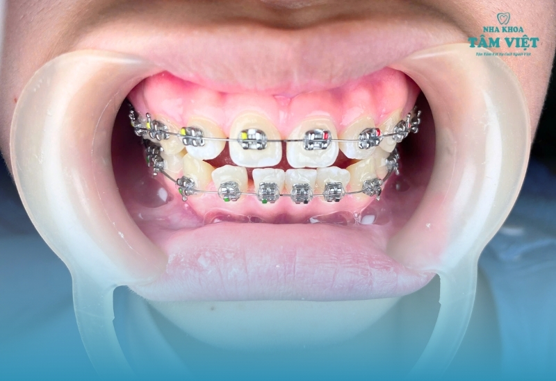 Mất răng có niềng răng được không và những điều cần lưu ý