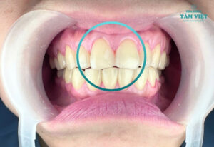 Nhổ răng cửa có nguy hiểm không? Đừng vội nếu chưa hiểu rõ!