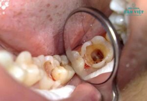 Trám răng lấy tủy có bền không? Những điều cần biết