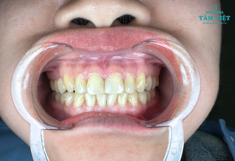 Trám răng lấy tủy có bền không? Những điều cần biết 2 Tuổi thọ trung bình của răng trám