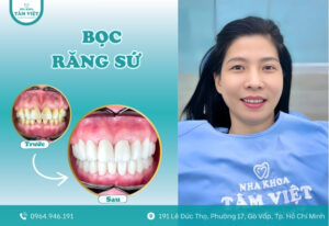 Bọc răng sứ bao nhiêu tiền 1 răng? Cập nhật giá mới nhất 2025
