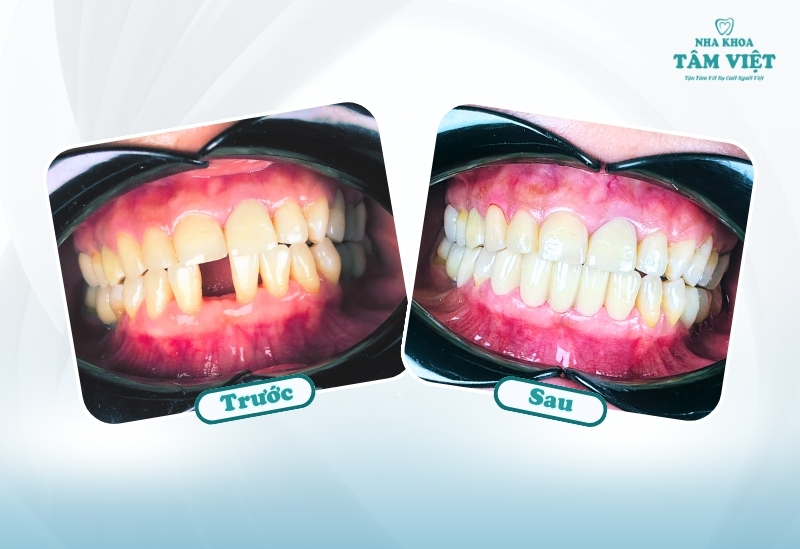 Bọc răng sứ bao nhiêu tiền 1 răng? Cập nhật giá mới nhất 2025 2 Bọc răng sứ bao nhiêu tiền 1 răng hiện nay?