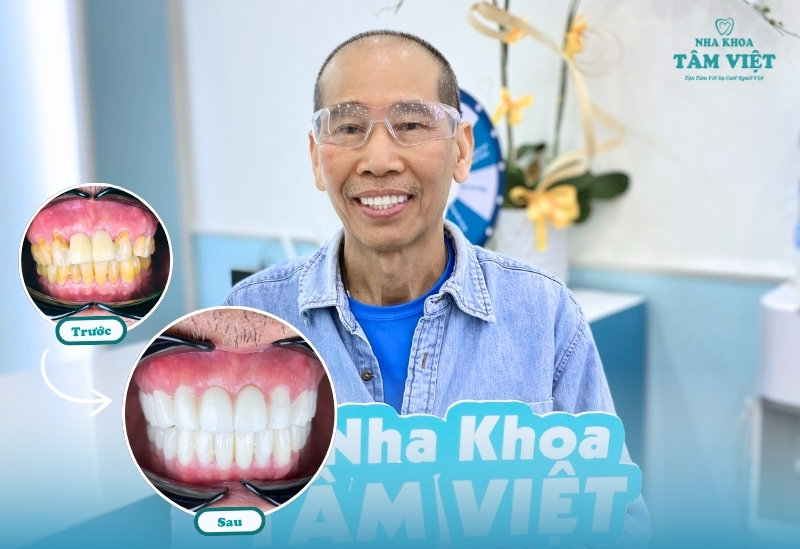 Bọc răng sứ chữa vẩu: Giải pháp cho nụ cười đẹp