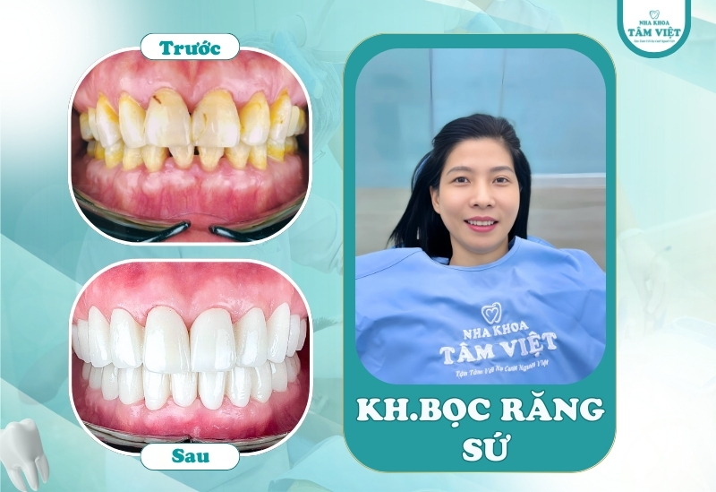 Bọc răng sứ chữa vẩu: Giải pháp cho nụ cười đẹp 4 Bọc răng sứ chữa vẩu có đau không?